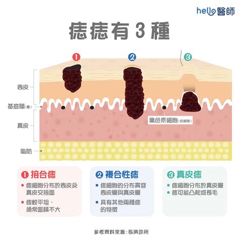 痣變大變凸|痣變大、痣多或長毛會變皮膚癌？認識痣的形成與原因